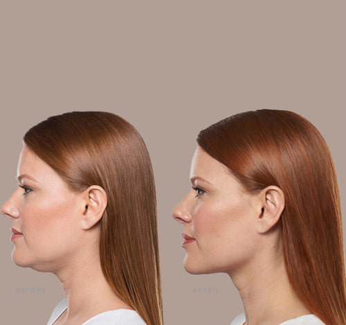 Kybella®